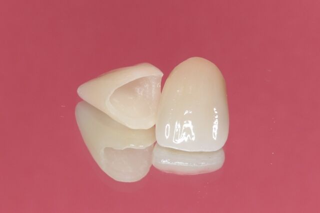 歯の治療なんだけどジルコニアにするか悩む