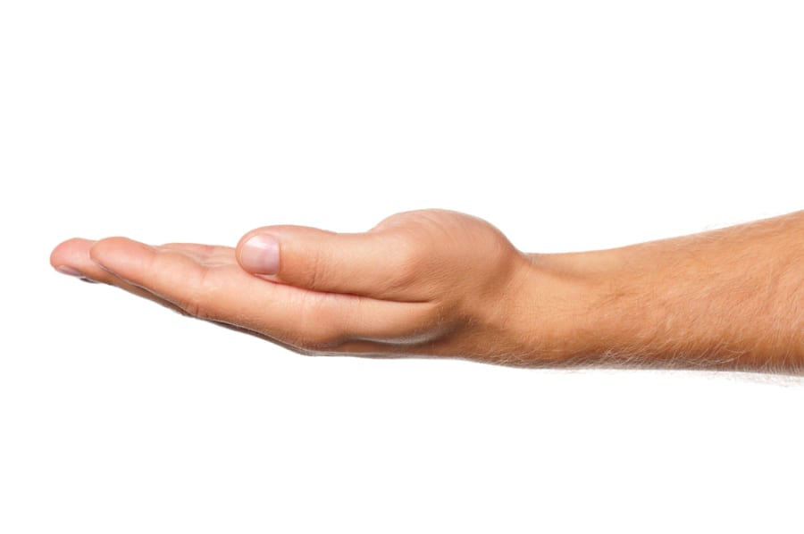 親指の伸びで「大動脈瘤の有無」がすぐ分かる!?簡単な片手診断テスト