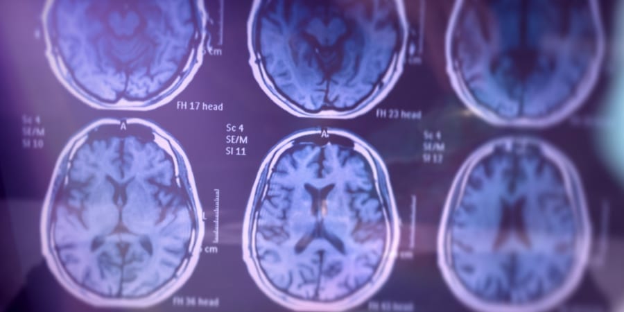 がん患者がアルツハイマー病を発症しにくい理由が見えてきた