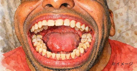 【驚愕】世界一「歯が多い」男性、30代でそのことに気づくｗｗｗ