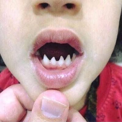 【画像】医師『”こういう歯”してる人、梅毒の親から生まれた子供の特徴です』