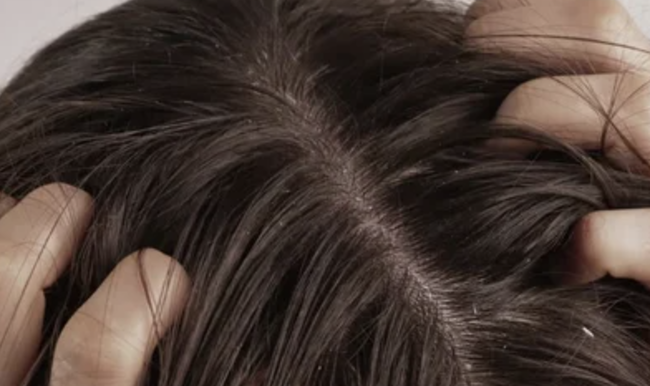 【画像】フケが多すぎるワイの寝起き枕www