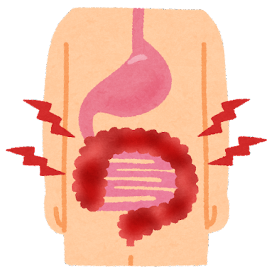 【緊急】大腸ガンがステージ4で発見されるまでの経緯がこちら