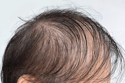 【朗報】ノーベル賞級の育毛剤、ついに見つかるwww