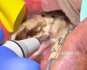 【動画】異次元に溜まった歯石を除去する歯医者さんのお仕事。