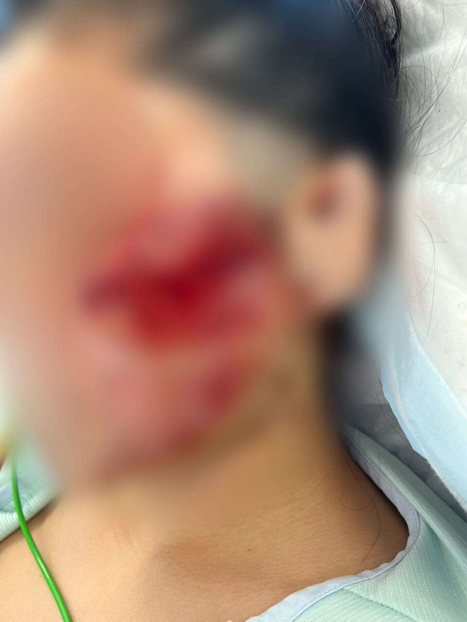 「地獄に突き落とされた感覚。こんな傷だらけになってしまって…」美容が好きだった20代女性　飲酒運転で二度と戻らなくなった顔と身体　念願の留学も白紙に…
