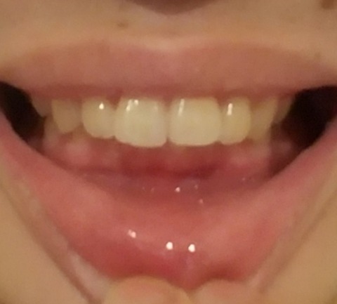 【ﾀｽｹﾃ】上の歯が下の歯を覆い隠してるんだが