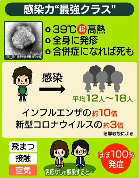 はしか大流行。お前らの想像の数十倍は流行