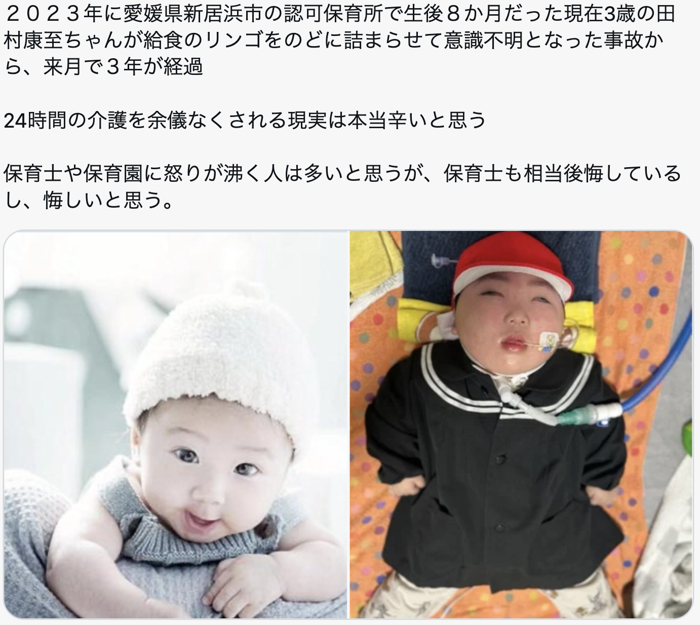 【警告】生後8か月の赤ちゃん、リンゴを喉に詰まらせて3年間ずっとこの状態