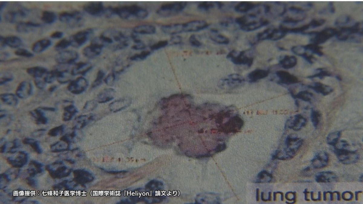 デスボール。70年後に死ぬ。広島で入市被爆した女性の肺からウランとデスボールが発見される。