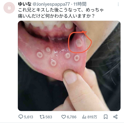 【画像】女の子、実の兄とキスをして口内炎をうつされるwww