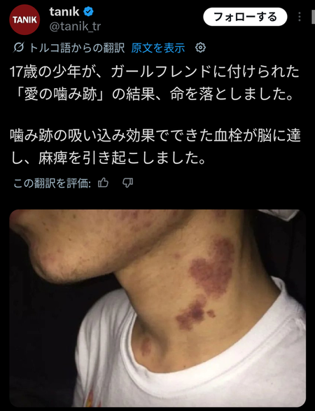 少年キスマークで死んてしまう