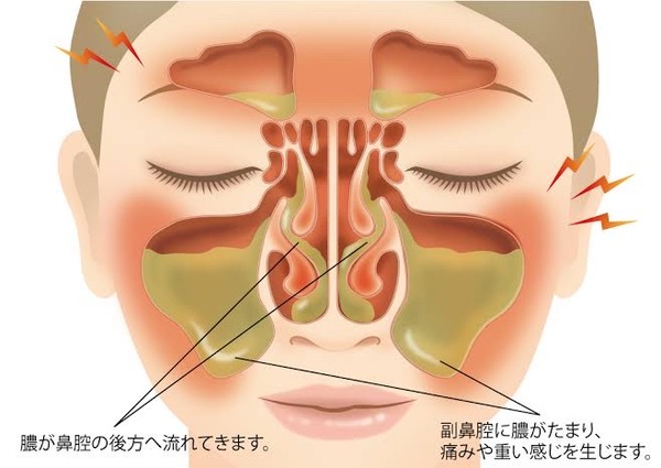 【悲報】蓄膿症、顔の中が膿だらけ