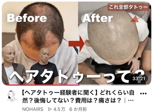 【画像】薄毛男性、タトゥーを入れて完全復活を遂げるwww