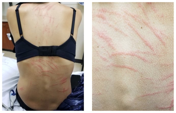 シイタケを食べた女性、背中に「鞭で打たれたような跡」が浮かび上がる症例