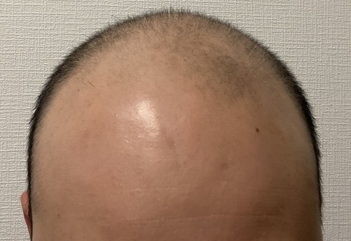 【画像】薄毛男子、たった半年で髪の毛を復活させてしまうwww