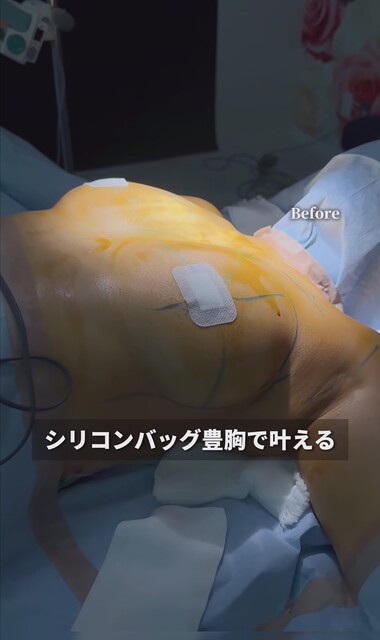 【画像】豊胸で100点お●ぱいｗｗｗ