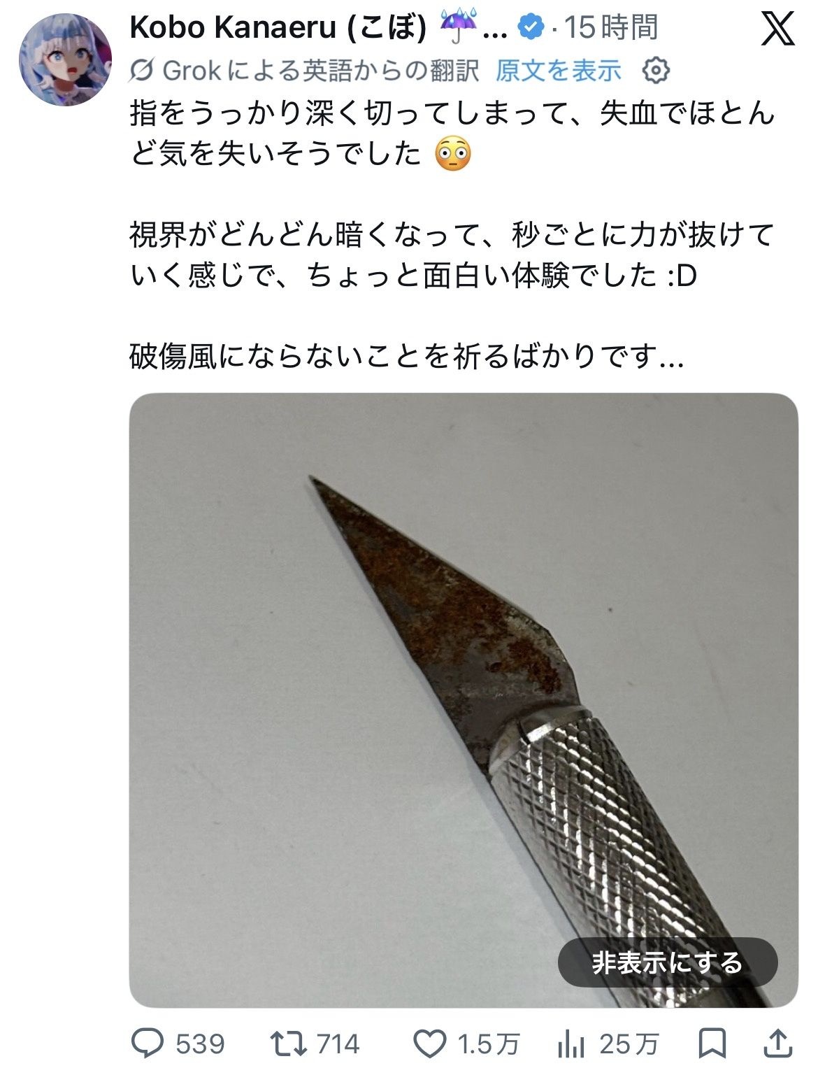 人気ホロライブVTuber、ヤバい怪我をする。おまえらの想像の1.3倍ヤバい