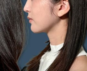 【画像】港区女子「顔の脂肪吸引神！めっちゃ垢抜ける～！」ﾊﾟｼｬｯ