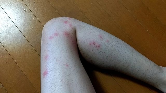 【画像】これ梅毒ちゃうよな？?